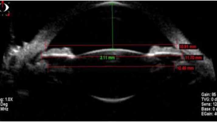 Direct Sulcus to Sulcus measur